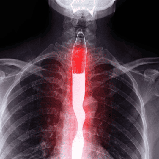 Cómo prevenir el silencioso cáncer de esófago oncocir clínica de ginecología y cirugía general en Madrid